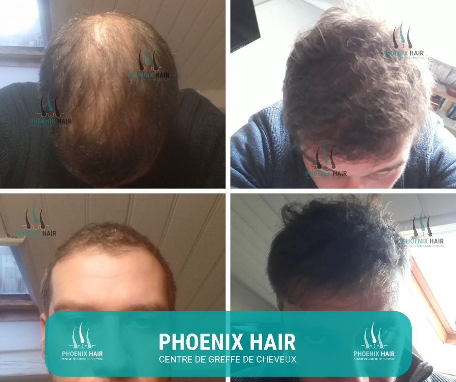 Phoenix Hair avant/après